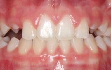 Before